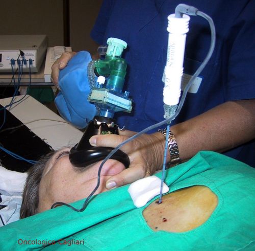 Sedo-analgesia durante termoablazione con radiofrequenze (TARF)