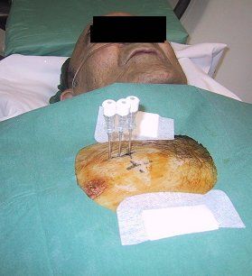 Posizionamento dell'agocannula in prossimità del tumore.