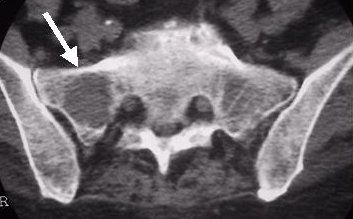 osteolisi sacrale (freccia).