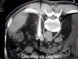 neoplasia del surrene sn. Controllo TC prima della termoablazione.