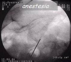 anestesia sul periostio