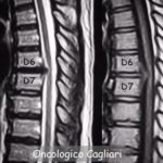 Discectomia dorsale