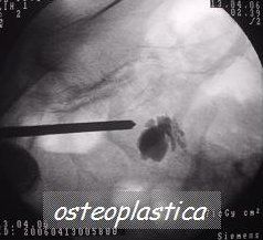 cementoplastatica