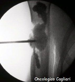 Cementoplastica