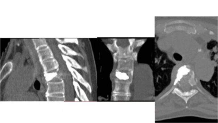 Microonde (MW) osso con vertebroplastica, caso 1