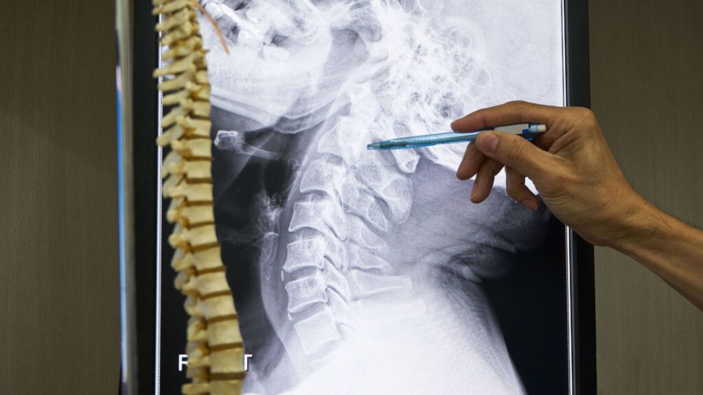 metastasi ossee voluminose e trattamenti ablativi