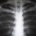 Metastasi ossee: tecniche ablative e osteoplastiche migliorano la prognosi