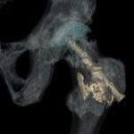 Metastasi ossee: cementoplastica con l’inserimento di viti cannulate